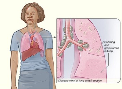 Xơ phổi liên quan tới bệnh sarcoidosis