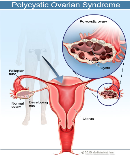 2011-polycystic-ovarian-syndrome