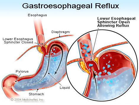 gastroesophageal1