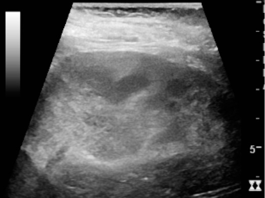 Ultrasonography of acute pyelonephritis
