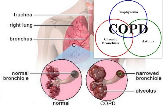 copd1a